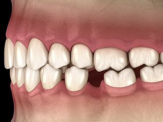 欠損歯を放置するリスク