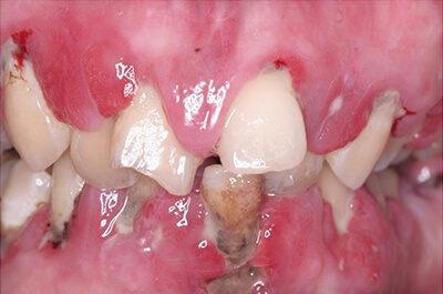 歯周病治療、審美歯科、インプラント1本、上部構造ハイブリッドセラミック 術前