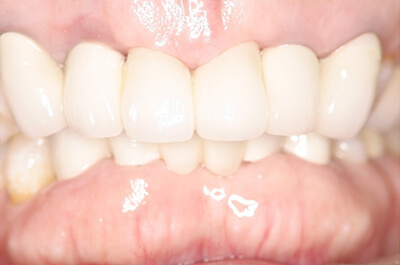 歯周病治療、審美歯科、インプラント1本、上部構造ハイブリッドセラミック 術後