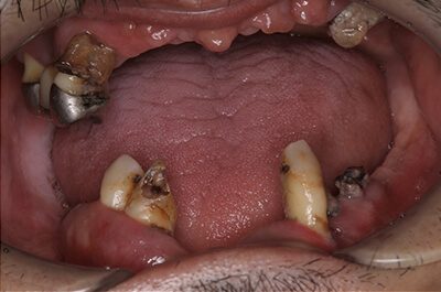 上顎左右サイナスリフトPRP使用、上下顎前歯GBRベニアグラフト,PRP使用、上顎8本12歯インプラント、下顎7本12歯インプラント、上部構造ハイブリッドセラミック(咬合確保・審美歯科) 術前