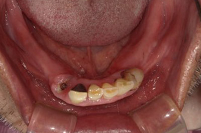 上顎左右サイナスリフトPRP使用、上下顎前歯GBRベニアグラフト,PRP使用、上顎8本12歯インプラント、下顎7本12歯インプラント、上部構造ハイブリッドセラミック(咬合確保・審美歯科) 術前