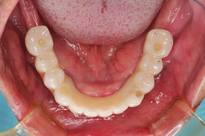 上顎左右サイナスリフトPRP使用、上下顎前歯GBRベニアグラフト,PRP使用、上顎8本12歯インプラント、下顎7本12歯インプラント、上部構造ハイブリッドセラミック(咬合確保・審美歯科) 術後