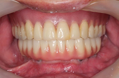 上顎左右サイナスリフトPRP使用、上下顎前歯GBRベニアグラフト,PRP使用、上顎8本12歯インプラント、下顎7本12歯インプラント、上部構造ハイブリッドセラミック(咬合確保・審美歯科) 術後