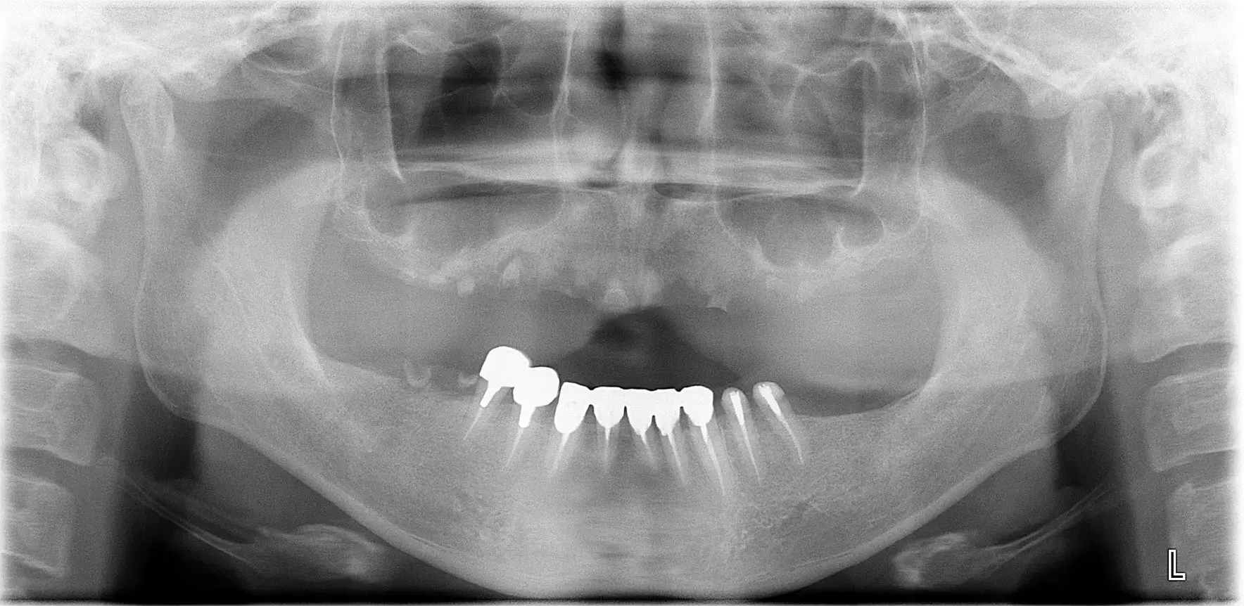 骨造成（GBR）、インプラント埋入、オールセラミッククラウン、all on 4