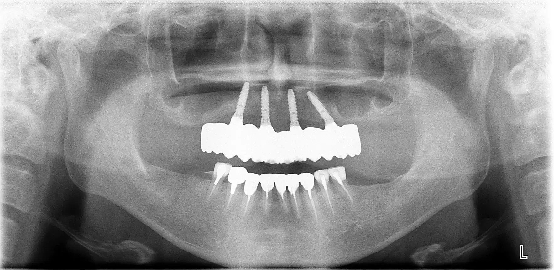 骨造成（GBR）、インプラント埋入、オールセラミッククラウン、all on 4