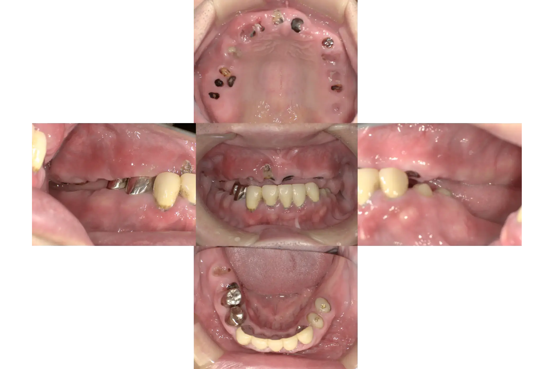 骨造成（GBR）、インプラント埋入、オールセラミッククラウン、all on 4