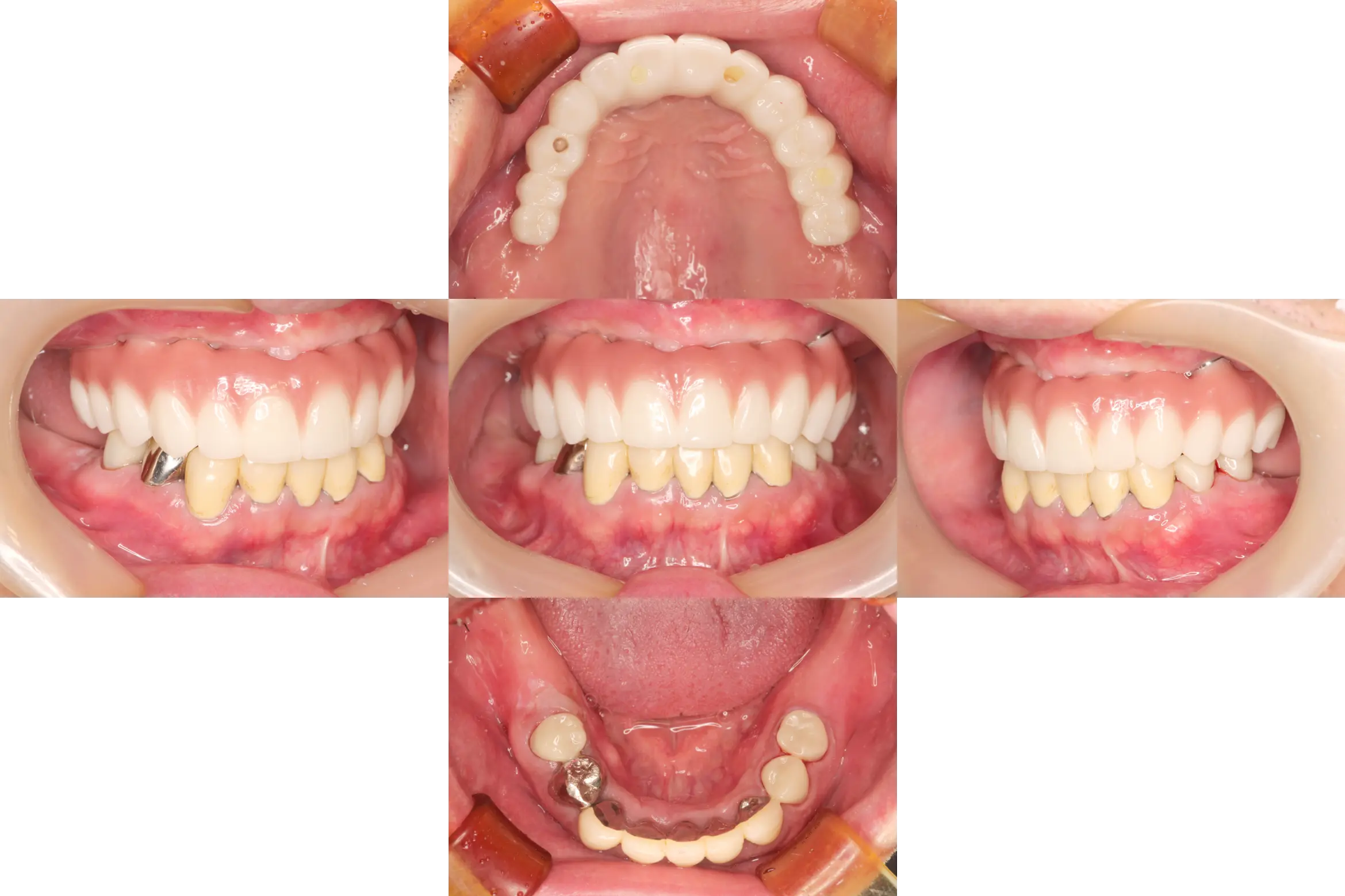 骨造成（GBR）、インプラント埋入、オールセラミッククラウン、all on 4